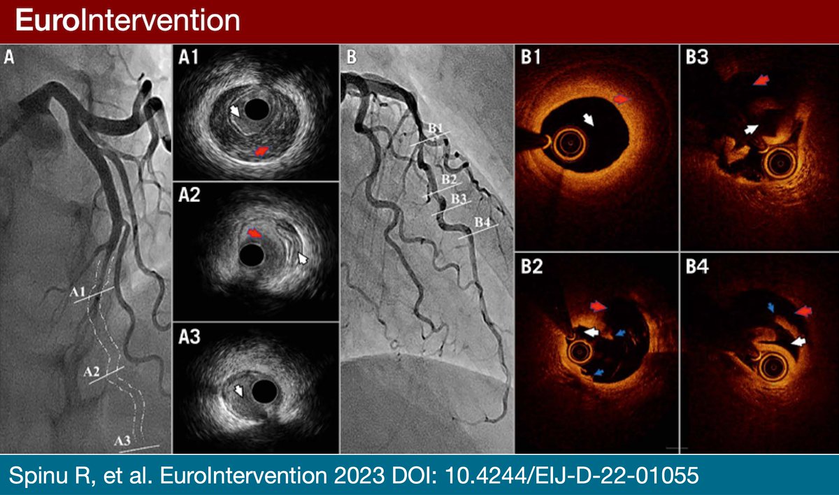 EuroInterventio's tweet photo. NEW AHEAD OF PRINT  "Aspiration technique in occlusive spontaneous coronary artery dissection". An Interventional Flashlight by @raduspinu et al. #EAPCI #CARDIOTWITTER https://t.co/4mVCpEhwjD https://t.co/9CMlgqq7lp