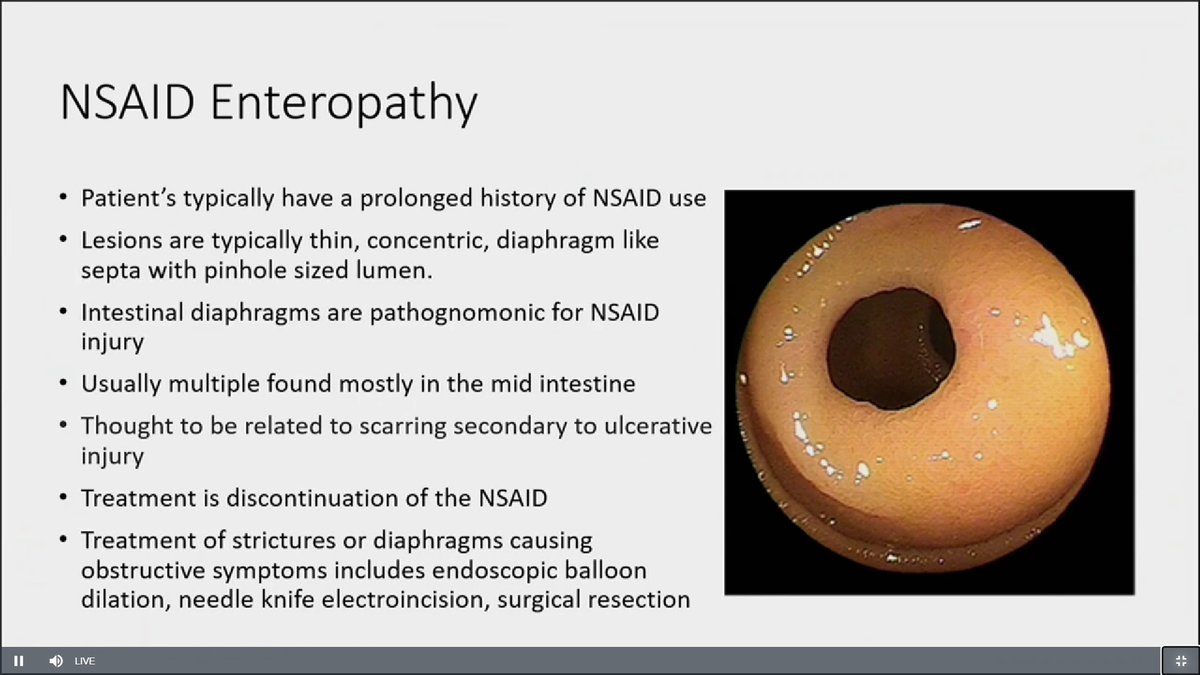 drRobinDud's tweet photo. 2/2 @CleClinicMD
@ibdlive

Cryptogenic Multifocal Ulcerous Stenosing Enteritis  (#CMUSE)

✅CMUS treatment and differential diagnosis of small bowel strictures courtesy of Yale &amp; #IBDlive with Professor @MRegueiroMD 💪👏🫶

Have a Nice 🐣and Happy 🕊️Holitime for Everyone https://t.co/4q5G5KLh8Z