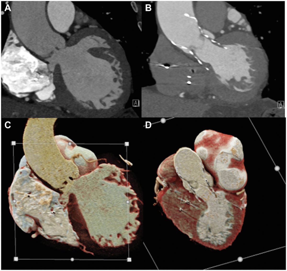 JACCJournals's tweet photo. #JACCCaseReports Quiz Answer: #TAVR is a safe option, even in the case of septal aneurysm and aortic regurgitation.
Let’s learn more on #howtodoit in this challenging case... Planning is key! https://t.co/KCsC1k9ODN
Thanks for voting! #CathLab #CardioTwitter https://t.co/bz8QxxshlZ
