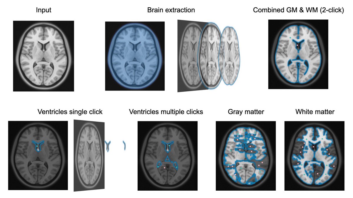 Some early examples of Meta's new SAM model on MRI.🧠🤖

Decent job segmenting large contiguous objects. 
- great fully-automated brain extraction🥇
- 2 click combined GM/WM seg
- 4 click ventricle seg

Haven't got GM and WM segs working yet, possibly to tortuous of structures 🔀