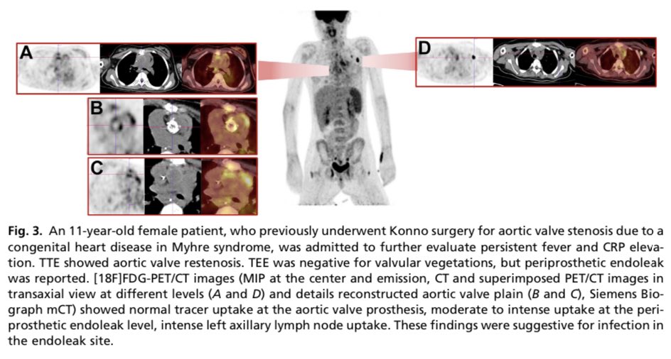 ☢️ Radionuclide Imaging of Infective Endocarditis #CardioEd #Cardiology #CardioTwitter #CVnuc