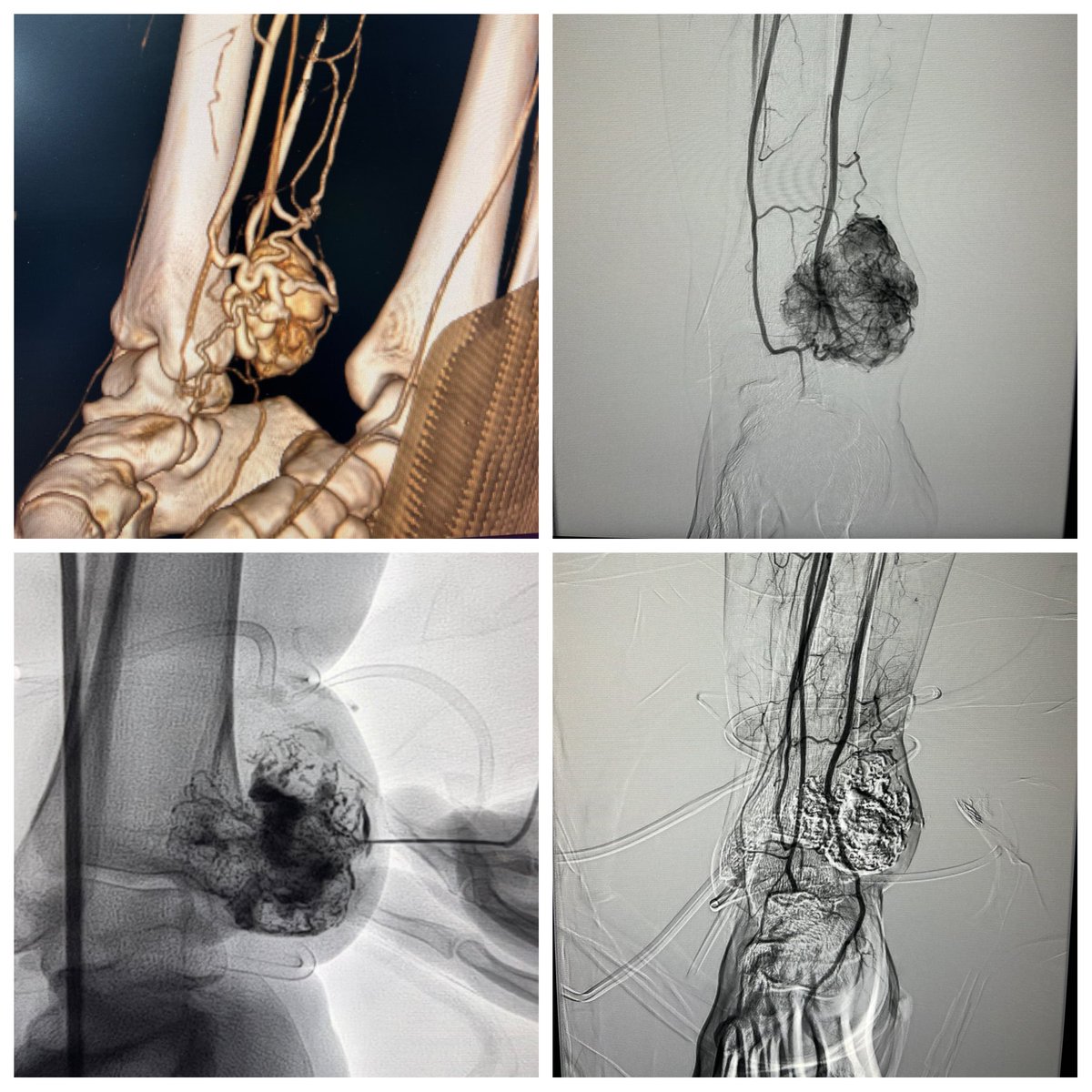 Udit Chauhan,Intervention Radiologist 🇮🇳 tweet media