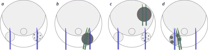 European Urology Oncology (@eururoloncol) on Twitter photo Throwback Thursday: Analysis of Magnetic Resonance Imagingâdirected Biopsy Strategies for Changing the Paradigm of Prostate Cancer Diagnosis
buff.ly/2PNM1hk
<a href="/IvoSchootsNL/">Ivo Schoots</a> <a href="/ProfPadhani/">Anwar Padhani</a> <a href="/JelleBarentsz/">Jelle Barentsz</a>
#prostatecancer #ThrowbackThursday Throwback Thursday: Analysis of Magnetic Resonance Imagingâdirected Biopsy Strategies for Changing the Paradigm of Prostate Cancer Diagnosis
buff.ly/2PNM1hk
<a href="/IvoSchootsNL/">Ivo Schoots</a> <a href="/ProfPadhani/">Anwar Padhani</a> <a href="/JelleBarentsz/">Jelle Barentsz</a>
#prostatecancer #ThrowbackThursday
