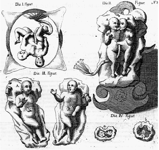 StoriaDellaMedicina (@storiamedicina) on Twitter photo Johannes Fatio was the first #surgeon to report a successful separation of conjoined twins, in Basel on 23 November 1689.
The twins, Catherine and Elisabeth, were connected at birth between the xiphoid process and the navel.
#histmed #historiamedica <a href="/SurgeryLegends/">Legends Of Surgery</a> #surgery Johannes Fatio was the first #surgeon to report a successful separation of conjoined twins, in Basel on 23 November 1689.
The twins, Catherine and Elisabeth, were connected at birth between the xiphoid process and the navel.
#histmed #historiamedica <a href="/SurgeryLegends/">Legends Of Surgery</a> #surgery
