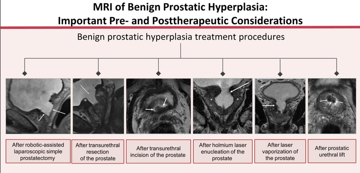 "MRI of Benign Prostatic Hyperplasia: Important Pre- and Post Therapeutic Considerations".
pubs.rsna.org/doi/10.1148/rg… 
Check out this great article from <a href="/femmyrads/">Elizabeth Han, MD</a> <a href="/RadsKarthik/">Karthik Sundaram, MD, PhD</a> <a href="/KNandalur/">Kiran Nandalur, M.D.</a> and team - a lot of hard work went into this. Thanks for letting me contribute and thanks to