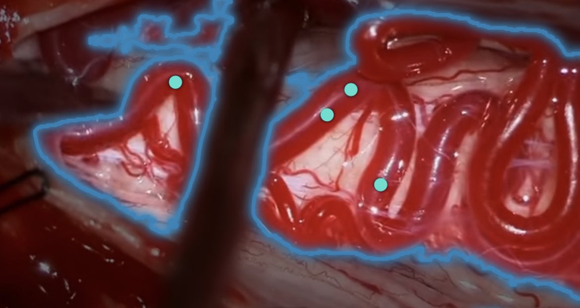 Paul Pöser (@poeserp) on Twitter photo Just tried out SAM with Data from a <a href="/BarrowNeuro/">BarrowNeurological</a> Spinal Cord
Perimedullary Fistula case .I highly recommend trying it yourself! MRI works ever greater!
Exciting times !
Here’s the link:
Segment Anything | Meta AI Just tried out SAM with Data from a <a href="/BarrowNeuro/">BarrowNeurological</a> Spinal Cord
Perimedullary Fistula case .I highly recommend trying it yourself! MRI works ever greater!
Exciting times !
Here’s the link:
Segment Anything | Meta AI
