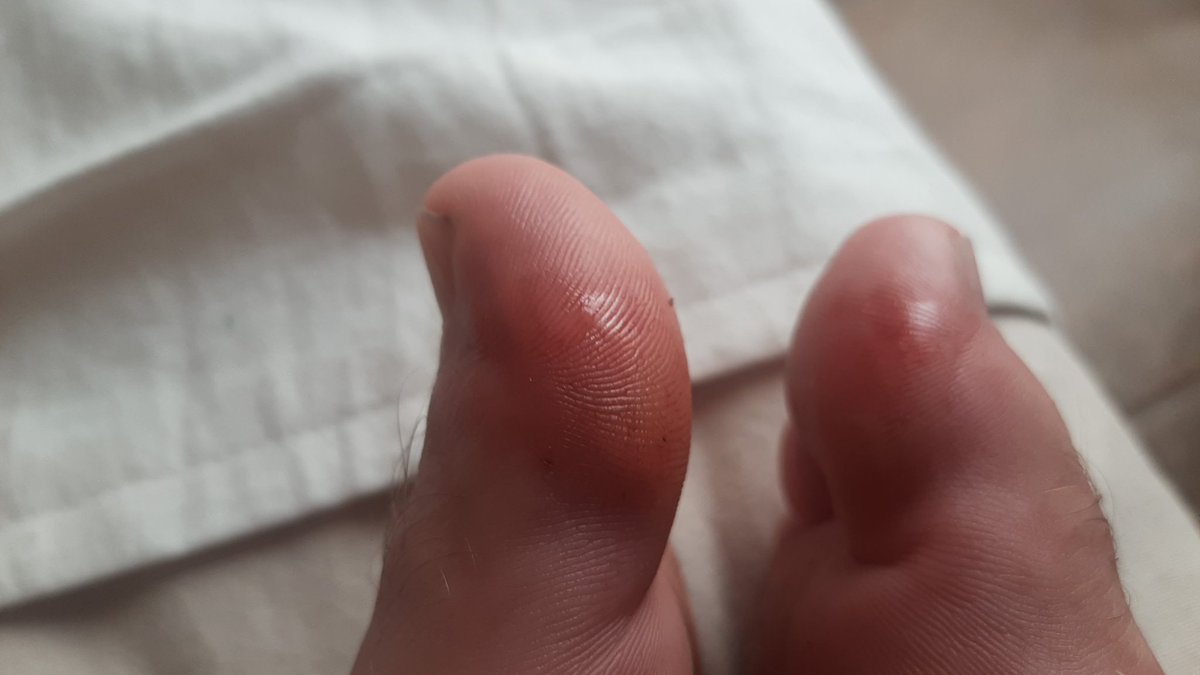 Eso pasa cuando no te pones botines con tapones hace mucho