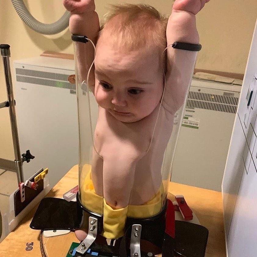 EnsedeCiencia's tweet photo. Este bebé está recibiendo una radiografía, y el curioso dispositivo que puedes ver es indispensable para dicho proceso.

Se llama Pigg-O-Stat, y fue fabricado por una razón muy importante. Funciona como un dispositivo pediátrico de inmovilización diseñado para colocar a bebés y niños pequeños y mantenerlos inmóviles mientras se toman radiografías. Aunque parece aterrador, en realidad limita la cantidad de tiempo y la exposición a la radiación necesaria para obtener las imágenes indispensables para establecer un diagnóstico.