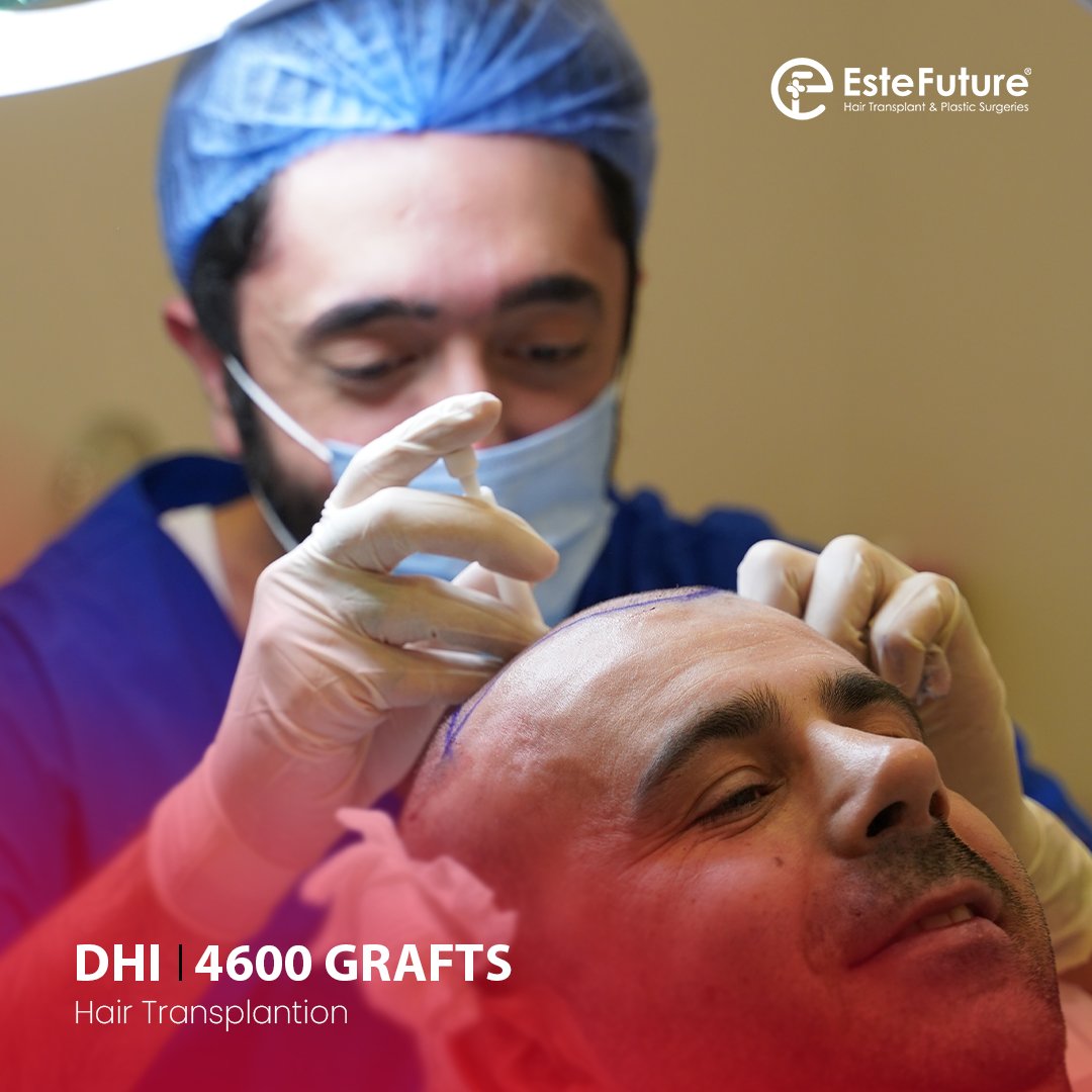 este_future's tweet image. Olcay Bey's pleasant and #painless #hair transplant procedure. 4600 #grafts were #transplanted to our patient with #DHI Technique. #EsteFuture