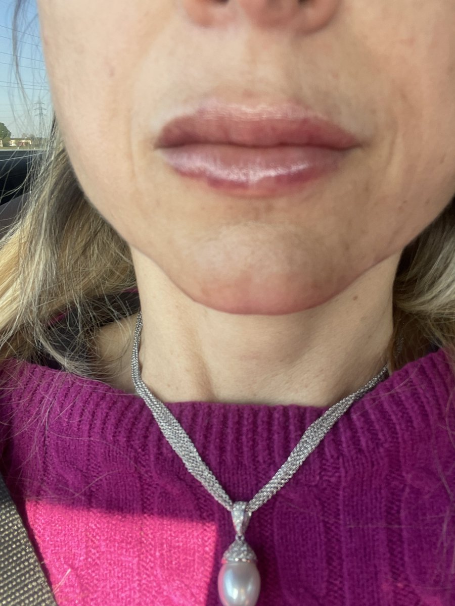 DanielaSchicchi's tweet photo. #lipfiller fatto dalla mia Dok di fiducia, Alessandra Cecchini. Nemmeno 24 ore dopo. Il gusto estetico, l’abilità e la professionalità sono le cose che mi hanno convinta ad affidarmi a lei per realizzare il mio desiderio. Felicissima e soddisfatta già ora. #acidoialuronico https://t.co/5iWGw28eIe