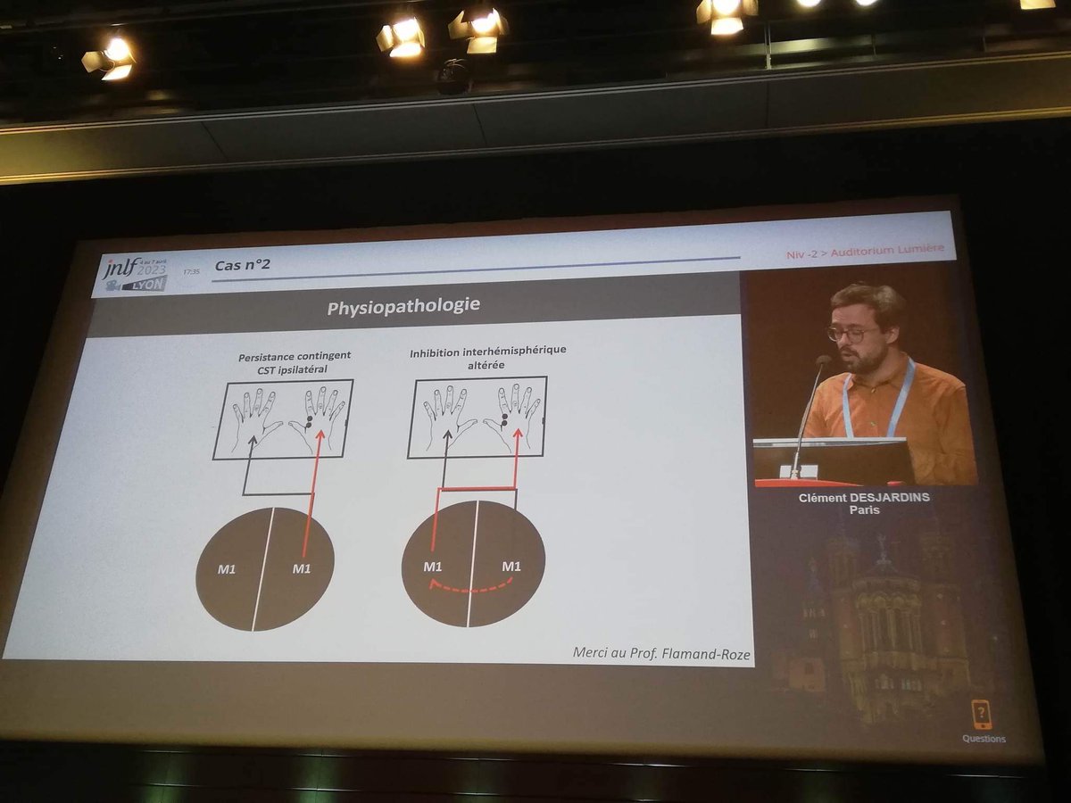 Heureux d’avoir présenté au Club des Mouvements Anormaux un cas de mouvements en miroir congénitaux @les_Jnlf #neurotwitterFR #neurotwitter #movementdisorder