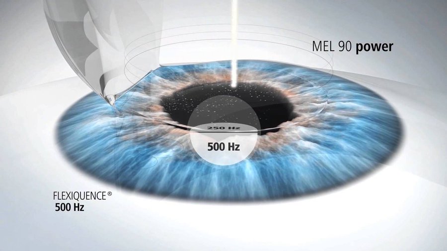 Historia de Colombia on Twitter "El LASIK (Laser assisted in Situ