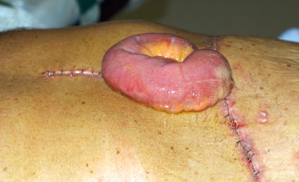DrATEFAHMED's tweet photo. #Burst #abdomen.
Loop of small #bowel #prolapsing through the #wound of a #malnourished #patient who had recently undergone a #Whipple’s procedure for pancreatic cancer. A leak of Fluid through the wound had prompted the registrar to remove the staples at the centre of the wound https://t.co/lGLQkJlLAx