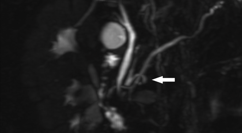 JPGNonline's tweet image. 12y boy admitted for recurrent abdominal pain leading to restricted food intake. Amylase  was 2,254 U/L. No hyperbilirubinemia. Normal US. MRCP was performed. 

What is the most likely diagnosis?

Answer and learn more 👉 bit.ly/3C9ldzo

#imageofthemonth #quickpoll