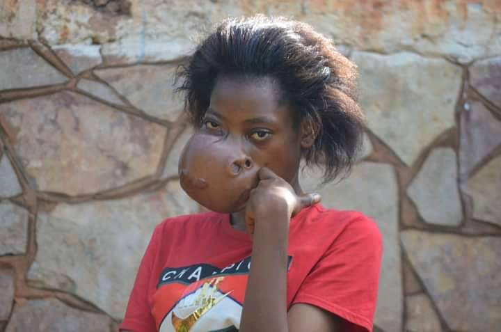 💥Du  6 et le 14 mai 2023, si vous souffrez de malformations, inscrivez-vous et faites vous opérer  gratuitement à l'hôpital militaire de Yaoundé.💥