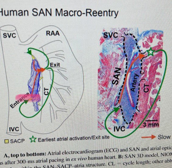 Martin Stiles (@martinkstiles) on Twitter photo <a href="/HoneyBadgerEP/">Vadim Fedorov Lab</a> <a href="/ABI_bioeng/">ABI</a> <a href="/JichaoZhao/">Jichao Zhao</a> <a href="/PrashSanders/">Prash Sanders</a> <a href="/peterkistler3/">peterkistler MBBS PhD FHRS</a> <a href="/thecsanz/">CSANZ</a> So the day after I hear <a href="/HoneyBadgerEP/">Vadim Fedorov Lab</a> describe sinus node reentry in intricate detail, I have a case! See the white line w blue dots of the crista and success ablating entrance site just like his diagram. Green good entrainment. Hoping LV improves now incessant tach gone! <a href="/HoneyBadgerEP/">Vadim Fedorov Lab</a> <a href="/ABI_bioeng/">ABI</a> <a href="/JichaoZhao/">Jichao Zhao</a> <a href="/PrashSanders/">Prash Sanders</a> <a href="/peterkistler3/">peterkistler MBBS PhD FHRS</a> <a href="/thecsanz/">CSANZ</a> So the day after I hear <a href="/HoneyBadgerEP/">Vadim Fedorov Lab</a> describe sinus node reentry in intricate detail, I have a case! See the white line w blue dots of the crista and success ablating entrance site just like his diagram. Green good entrainment. Hoping LV improves now incessant tach gone!