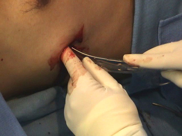 ProcedureDocs's tweet image. Pigtail Catheters vs Large-Bore Chest Tubes for Traumatic Hemothorax hospitalprocedures.org/pigtail-cathet…