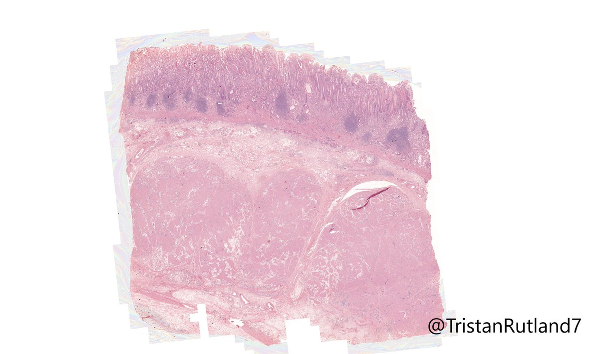 TristanRutland7's tweet image. 🥚🐰Happy Easter all!

✏️Short case this week as it holidays.

⚕️Adult, small bowel and stomach

#GIpath #IDpath #Pathtwitter #pathresidents