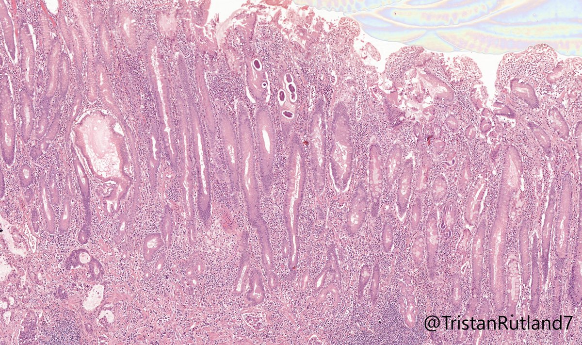 TristanRutland7's tweet image. 🥚🐰Happy Easter all!

✏️Short case this week as it holidays.

⚕️Adult, small bowel and stomach

#GIpath #IDpath #Pathtwitter #pathresidents