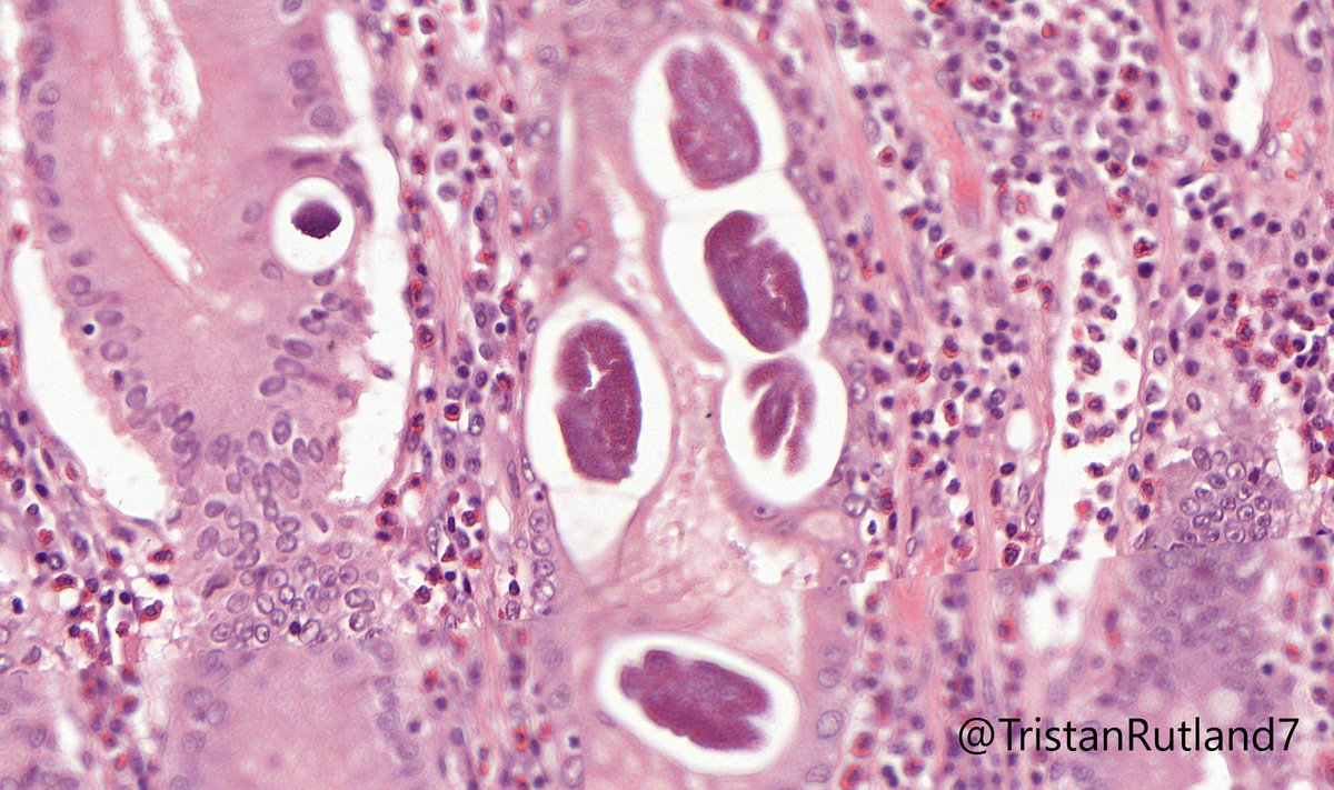 TristanRutland7's tweet image. 🥚🐰Happy Easter all!

✏️Short case this week as it holidays.

⚕️Adult, small bowel and stomach

#GIpath #IDpath #Pathtwitter #pathresidents