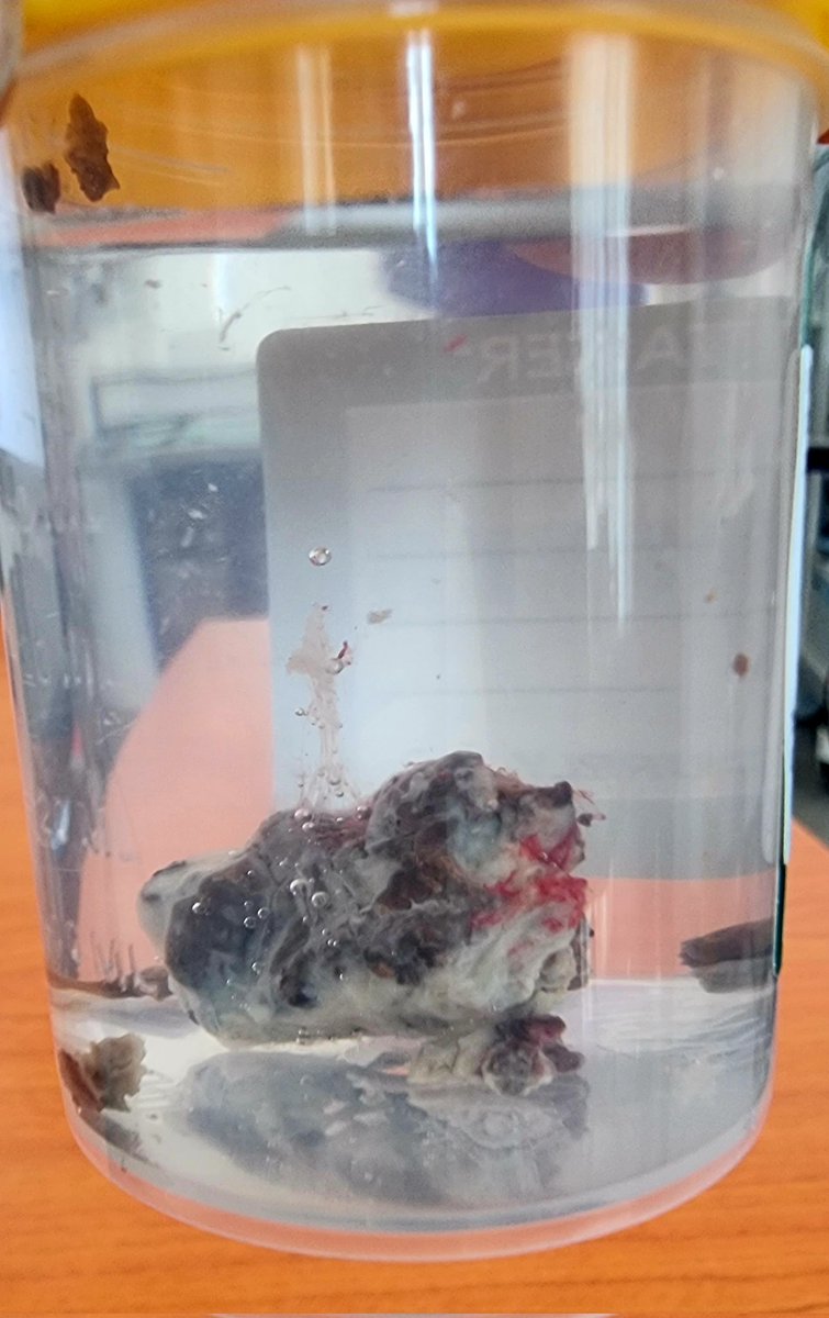 dryusrimusa's tweet photo. Foul smelling (halitosis) breath for nearly 2 years. I did nasoendoscopy and found this weird looking necrotic ball- the source of bad breath. Removed w some difficulties. I told her "tahun ni nafas baru bermula ramadan"😁 https://t.co/qklQTvKha5