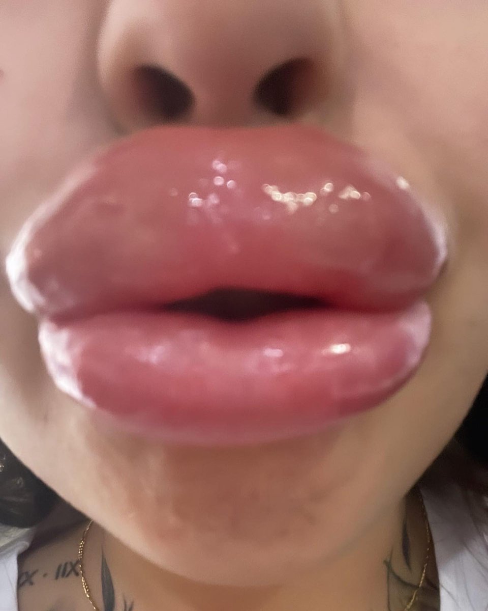 Lipaddictz's tweet photo. @christina_kaki Another ml in these beautiful lips! ππ #fake #lips #lipinjections #plastic #swollen #lipgap #juvederm #filler #addict #lipfetish #plasticsurgery #plasticpositive https://t.co/oUEarcVTWD