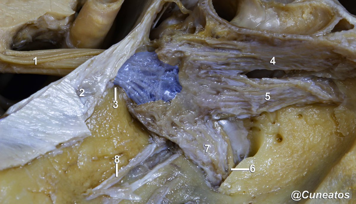Azul: espacio subaracnoideo dentro del Cavum de Meckel. 1. Nervio trigémino. 2. SPS, 3. Incisura de Gruber, 4. División oftálmica del trigémino, 5. División Maxilar, 6. Nervio masticatorio de la división mandibular del trigémino (7), 8. Nervio petroso Sup &gt;. <a href="/NeurosurgA/">Neurosurgical Anatomy</a>