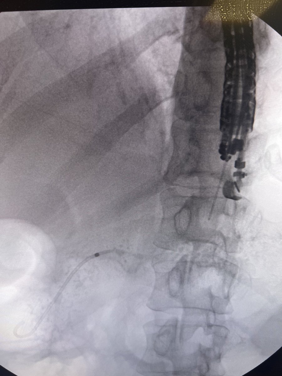 EUSandEndoscopy's tweet photo. Fluoro view of #EUS #CeliacPlexusBlock needle. PD stent placed during #ERCP for #ChronicPancreatitis s/p #PancreaticSphincterotomy & #PancreaticStones extraction & already had fluoro position & can see 20 gauge @CookMedical celiac block needle https://t.co/ZPGyCV89Xx