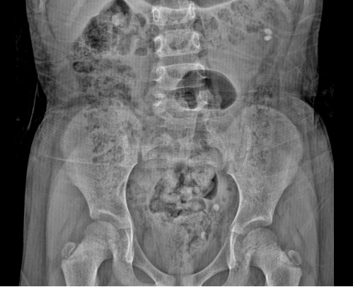 d_dorucu's tweet photo. 4 yo patient  with malrotated left kidney
She has a history of PCNL and RIRS last year.
Semirigid URS and RIRS was performed with TFL for recurrent ureteral and kidney stones

with @ytanidir, @Casekerci, @MarmaraUroloji https://t.co/Qk5dDeKPbZ