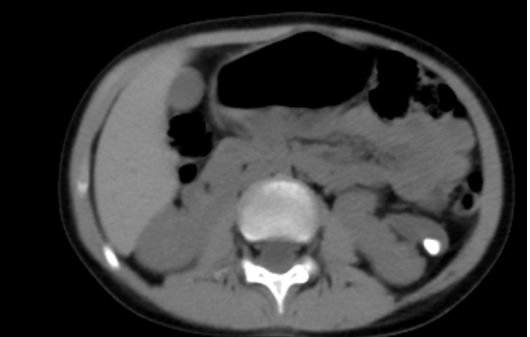 d_dorucu's tweet photo. 4 yo patient  with malrotated left kidney
She has a history of PCNL and RIRS last year.
Semirigid URS and RIRS was performed with TFL for recurrent ureteral and kidney stones

with @ytanidir, @Casekerci, @MarmaraUroloji https://t.co/Qk5dDeKPbZ