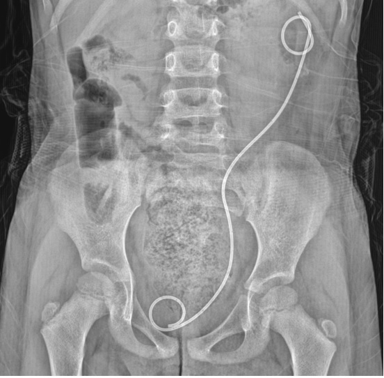 d_dorucu's tweet photo. 4 yo patient  with malrotated left kidney
She has a history of PCNL and RIRS last year.
Semirigid URS and RIRS was performed with TFL for recurrent ureteral and kidney stones

with @ytanidir, @Casekerci, @MarmaraUroloji https://t.co/Qk5dDeKPbZ