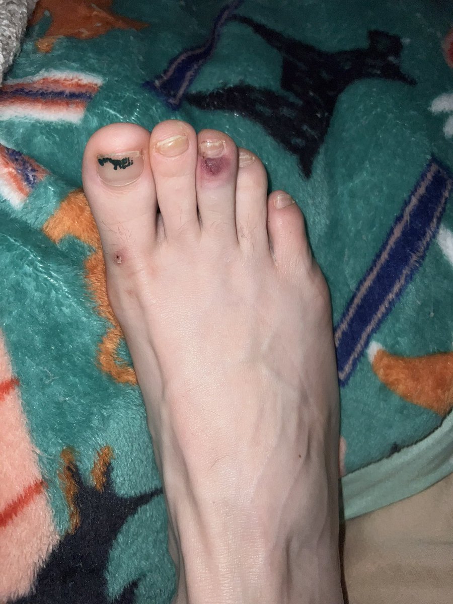 Runner toes, some ~16 weeks into this marathon training cycle. But, the bruised middle toe is from dropping a glass plate on it yesterday. The plate is intact, my toe, barely 😅 #bibchat #marathontraining