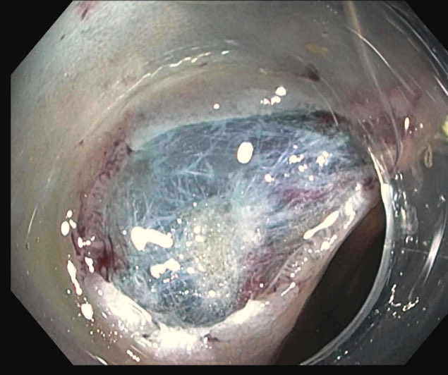 EUSandEndoscopy's tweet photo. When you put a clear distal cap on the #PedsColonoscope during 1 yr fu of prior large #colonpolyp #EMR so #GIFellow gets experience do #Colonoscopy w cap attached &amp; find new 1 cm polyp to teach EMR with cap already on! https://t.co/oAV5BQ1mJH
