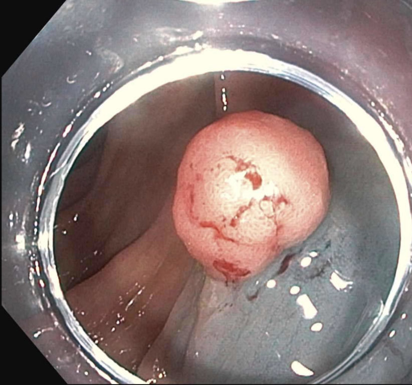 EUSandEndoscopy's tweet photo. When you put a clear distal cap on the #PedsColonoscope during 1 yr fu of prior large #colonpolyp #EMR so #GIFellow gets experience do #Colonoscopy w cap attached &amp; find new 1 cm polyp to teach EMR with cap already on! https://t.co/oAV5BQ1mJH