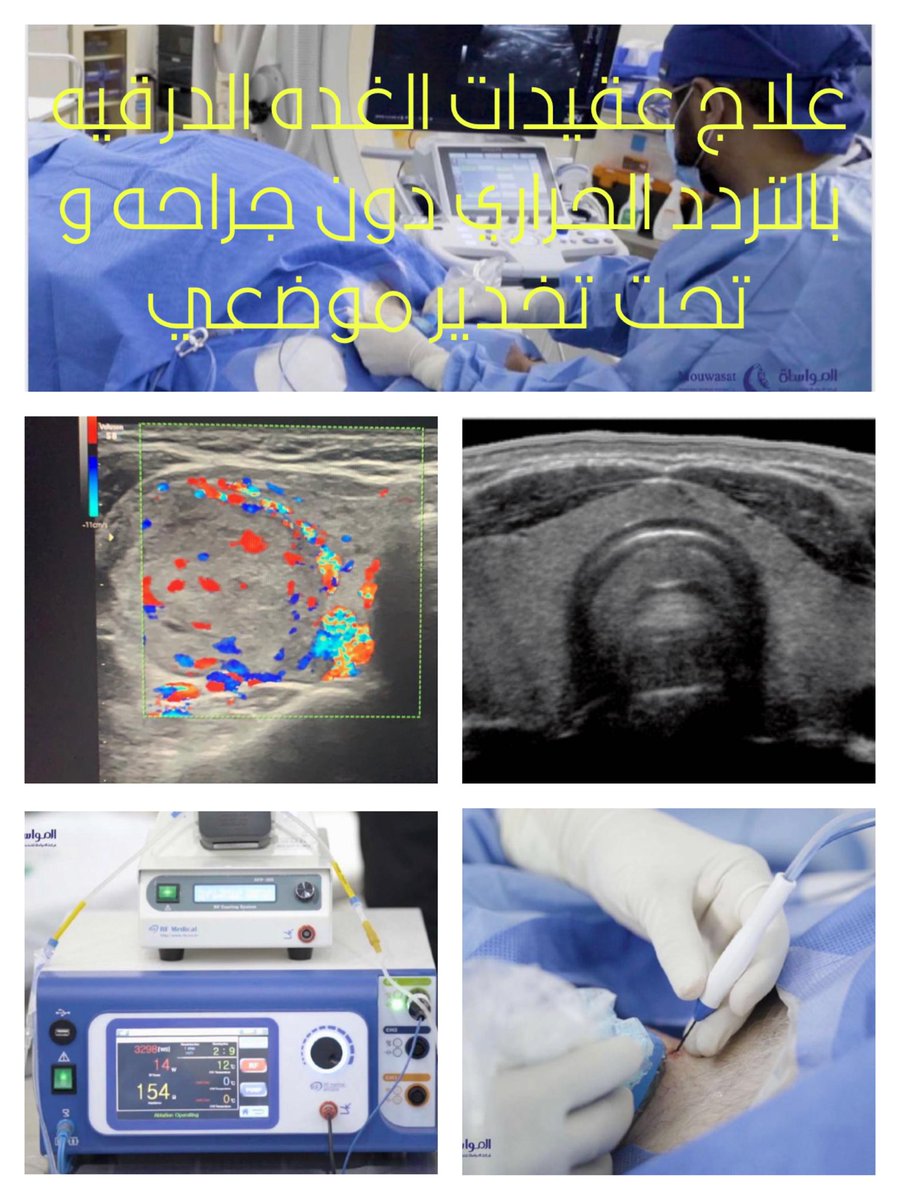 دور فعال لعلاج العقيدات الحميدة في الغدة الدرقية بأحدث التقنيات عن طريق التردد الحراري والتي هي خيار اخر عن الجراحه التقليديه و بتخدير موضعي و بدون شقوق جراحية و سرعة التعافي دون التأثير علي وظائف الغدة الدرقية بإذن الله
و ضمور حجم العقيده الي
٨٥٪ في ٤-٦ اشهر