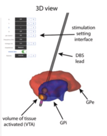 MichaelOkun's tweet photo. Kelly Mills @JohnsHopkins nice editorial MAP DBS '1st step' in gathering efficacy evidence use imaging-influenced DBS programming in a real-world scenario.  Speed, access and challenges in under-served regions?  @DBSThinkTank  https://t.co/Czc60BmAbx https://t.co/nVYiIgkhV0