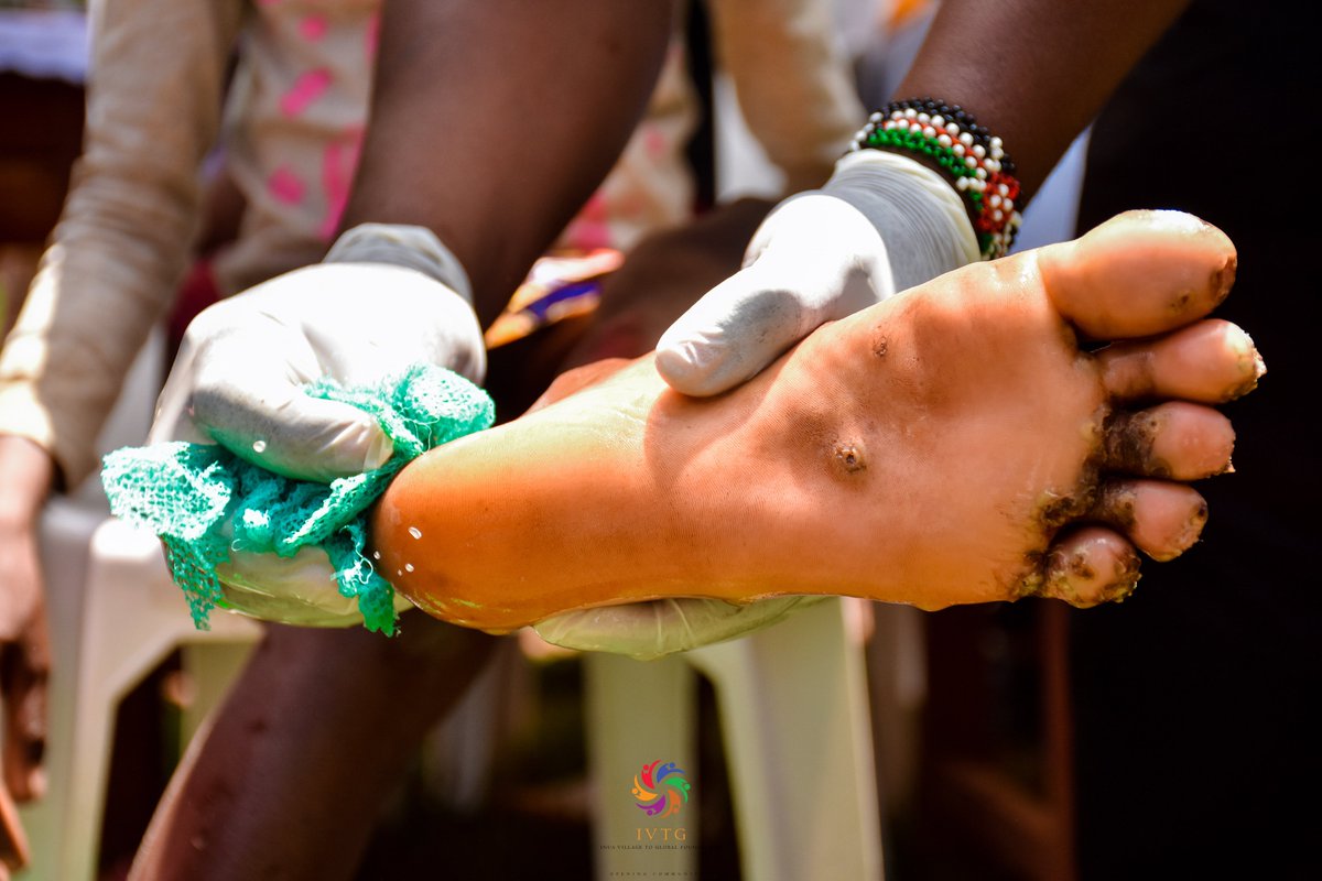 IVTGFoundation's tweet photo. A total of 100 households infested with jiggers have been reached and impacted. This number translates to over 800 people who have directly benefited from the intervention. https://t.co/JcSLfYpa80