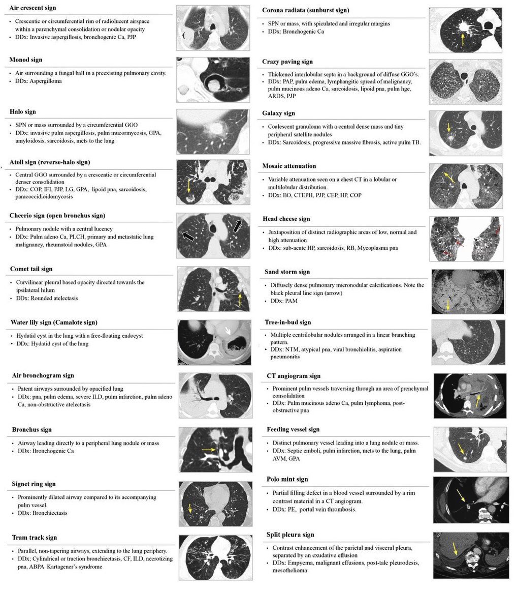 TheKoshurDoc's tweet photo. ▫️Chest 🩻 &amp; CT made easy
- Common signs and patterns

#MedEd #MedTwitter #radtwitter #ThreadEd
#ThreadGuy #ThreadDoc #TheThreadDoc
#ThreadTwitter @IhabFathiSulima https://t.co/oO0Jh8ZxuW