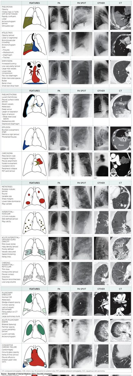 TheKoshurDoc's tweet photo. ▫️Chest 🩻 &amp; CT made easy
- Common signs and patterns

#MedEd #MedTwitter #radtwitter #ThreadEd
#ThreadGuy #ThreadDoc #TheThreadDoc
#ThreadTwitter @IhabFathiSulima https://t.co/oO0Jh8ZxuW