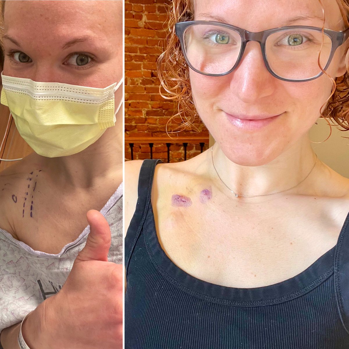 NoaErlitzki's tweet photo. Success! Port placement &amp; recovery were so much easier than I expected. They even used a low profile port to accommodate my small frame. My worries were unnecessary! Now off to go live my life 💃🏼 #IBDwontstopme
In other news, I submitted another grant app this week🤞🏻#MudPhud https://t.co/P8y4Rye4yI