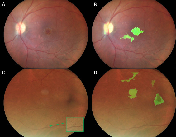 Performance of Automated Machine Learning for Diabetic Retinopathy Image Classification from Multi-field Handheld Retinal Images <a href="/PaoloAntonioMD/">Paolo Silva</a> ow.ly/TlSU50Nk0Vm