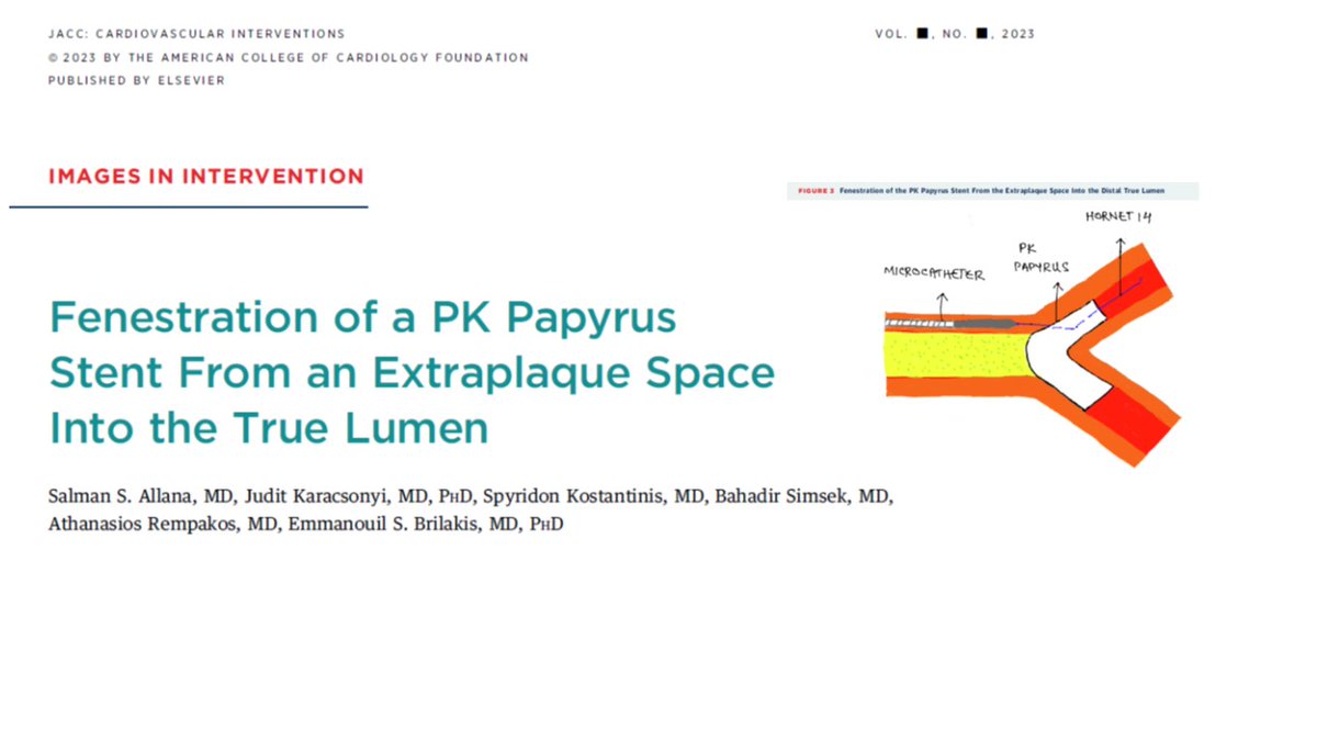 Salman Allana, MD FACC FSCAI (@allanasalman) on Twitter photo Now online <a href="/JACCJournals/">JACC Journals</a>
Fenestration of PK Papyrus stent during CTOI PCI from extraplaque space and subsequent challenges
<a href="/esbrilakis/">Emmanouil Brilakis</a> <a href="/JuditKaracsonyi/">Judit Karacsonyi</a> <a href="/S_Kostantinis/">Spyros Kostantinis</a> <a href="/BahadirSimsekMD/">Baha Simsek</a> <a href="/RempakosT/">Thanasis Rempakos</a> #CTO #PCI #CardioTwitter
link: authors.elsevier.com/a/1gsss_i2X-OT… Now online <a href="/JACCJournals/">JACC Journals</a>
Fenestration of PK Papyrus stent during CTOI PCI from extraplaque space and subsequent challenges
<a href="/esbrilakis/">Emmanouil Brilakis</a> <a href="/JuditKaracsonyi/">Judit Karacsonyi</a> <a href="/S_Kostantinis/">Spyros Kostantinis</a> <a href="/BahadirSimsekMD/">Baha Simsek</a> <a href="/RempakosT/">Thanasis Rempakos</a> #CTO #PCI #CardioTwitter
link: authors.elsevier.com/a/1gsss_i2X-OT…