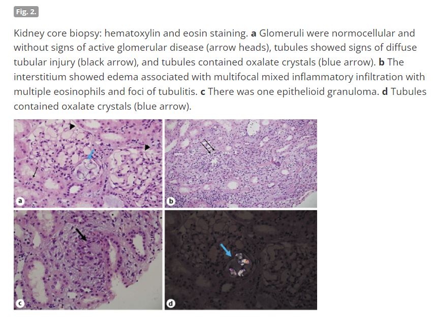 NephroKarger's tweet photo. Acute Kidney Injury following Exposure to Formaldehyde-Free Hair-Straightening Products
🔗 https://t.co/6CYmtXbjco
✍ Abu-Amer N. et al.
📖 #CaseRepNephrolDial
@DermaKarger
#OpenAccess #AKI #CosmeticProducts https://t.co/6X6ZVzG4H9