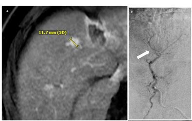 Boosted-Dose Yttrium-90 Radiation Segmentectomy or Lobectomy for #HepatocellularCarcinoma Refractory to Prior Transarterial #Embolization or #Chemoembolization: A Single Institution Retrospective Case Series
👉link.springer.com/article/10.100…
<a href="/ZTBerman/">Zach Berman MD</a>
