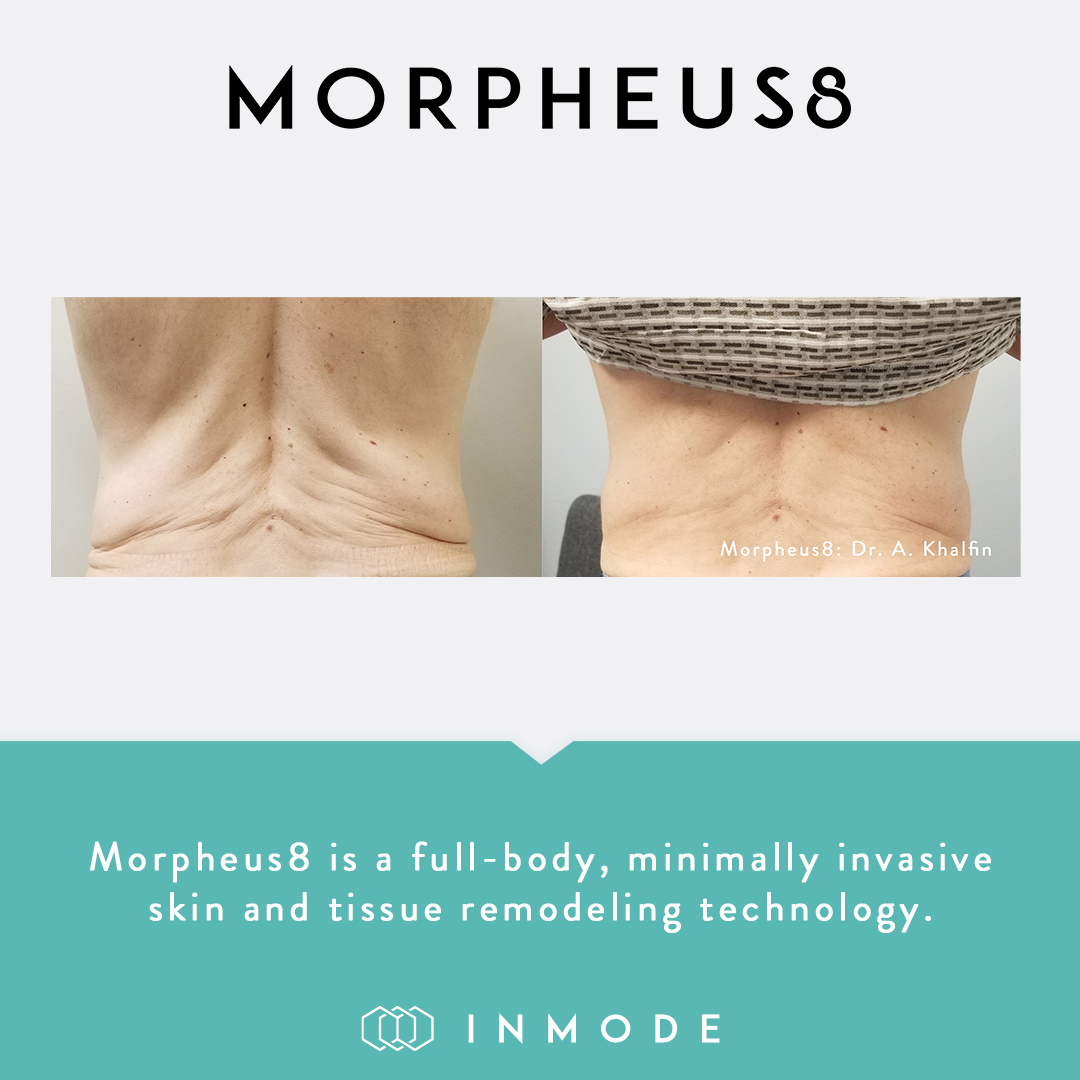 CelebrationOBG's tweet photo. Call us today to schedule your InMode Consultation at (877) 800-0239 or email us for more information at InMode@chealthwell.com.
#celebrationobgyn #wintergarden #inmode #morpheus8 #womenswellness #lumecca #vasculaze #diolazexl #laserhariremoval #tone #vtone https://t.co/M7PGboFNYt