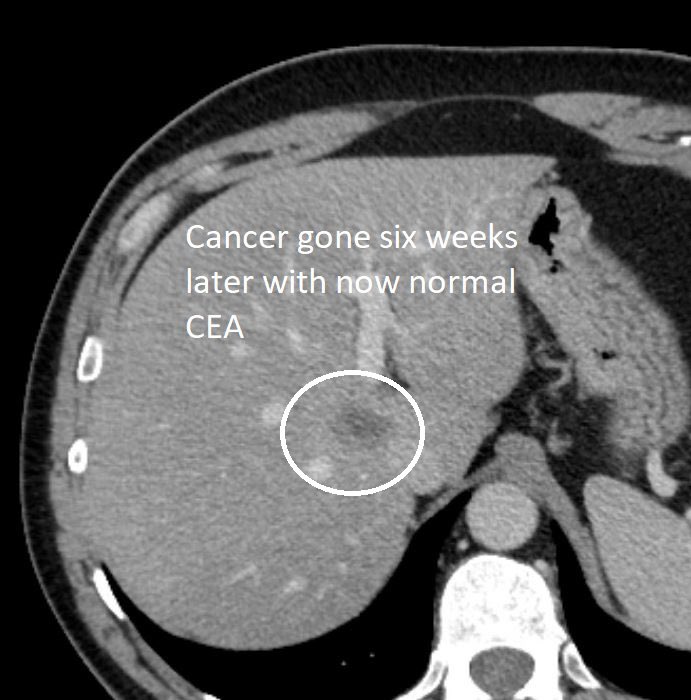 Small area of metastatic #coloncancer in the liver that was new & associated with increases in tumor markers. Due to the central location, the area was treated by irreversible electroporation (IRE) by interventional radiology (#IRad) with a nice response on follow up.