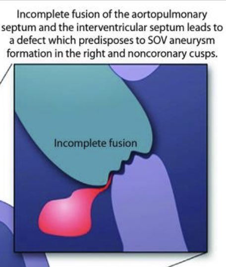 iamritu's tweet photo. why do most sinus of valsalva aneurysms involve the RCC?

Form follows function

Incomplete fusion of aorta pulmonary septum &amp;inter ventricular septum creates weakness in the central fibrous body? #echofirst 
https://t.co/tR02ONfAda
https://t.co/9TuHqDZupi
https://t.co/x0r9MlJjqE https://t.co/JoDFbMCFOR