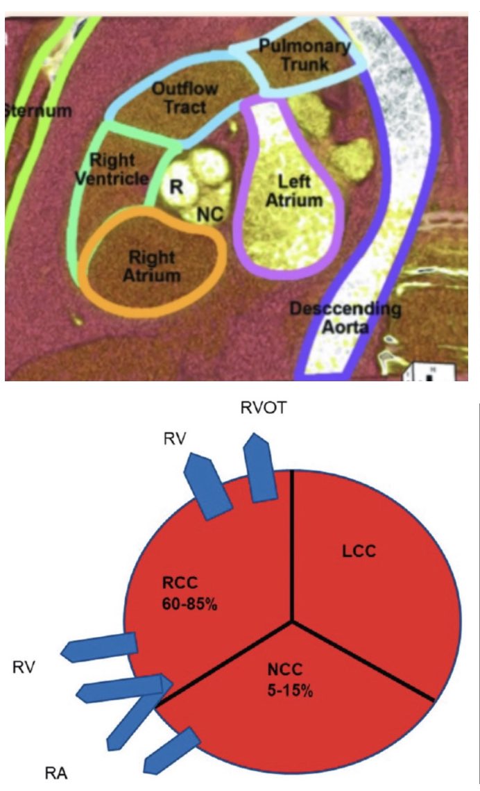 iamritu's tweet photo. why do most sinus of valsalva aneurysms involve the RCC?

Form follows function

Incomplete fusion of aorta pulmonary septum &amp;inter ventricular septum creates weakness in the central fibrous body? #echofirst 
https://t.co/tR02ONfAda
https://t.co/9TuHqDZupi
https://t.co/x0r9MlJjqE https://t.co/JoDFbMCFOR