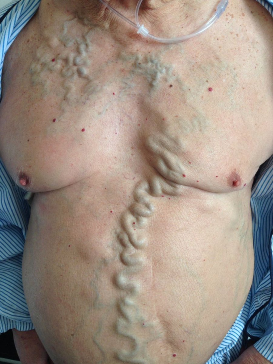 81-yo patient reporting distension of the veins in the neck and chest. He was otherwise completely asymptomatic. What do you think of?