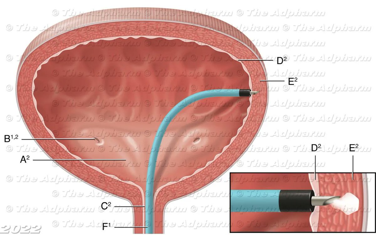 Botox injection into bladder detrusor muscle, illustrated by Jane Whitney, CMI.

Explore more of her work: buff.ly/3BQrCzm 

#botox #bladder #urology #anatomy #medicalillustration #medical #illustration #sciart #medart #medicalillustrator #biomedicalart #anatomicalart